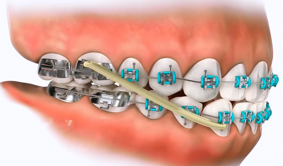 class III elastics